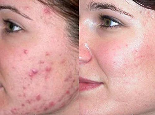 Best Acne Treatment for Face with Vitamin C for Men & Women. Use Acne Spot Treatment for Face for a Clear & Fresh Skin without Breakouts, Redness, Blemishes or Acne Scars. Results in 4 Weeks - 1 Fl Oz