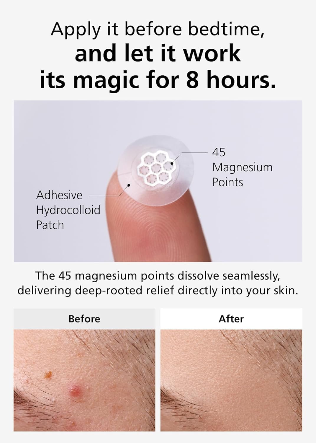 EasyDerm Micro Point Acne Patch Duo – 10 Magnesium Pimple Patches + 6 Real Calming Microdart Patches for Breakout & Post-Blemish Care, 2-Step K-Beauty Skincare Kit
