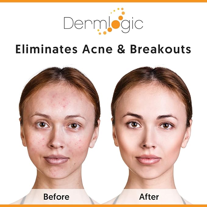 Acne Treatment Pads- Contains Salicylic, Glycolic, & Lactic Acid for Face & Body. Clears Away Clogged Pores, Oily Skin & Cystic Breakouts. Removes Dark Spots, Blackhead & Whitehead Pimples